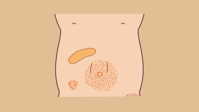 Masses abdominales chez l'adulte – ChirPod